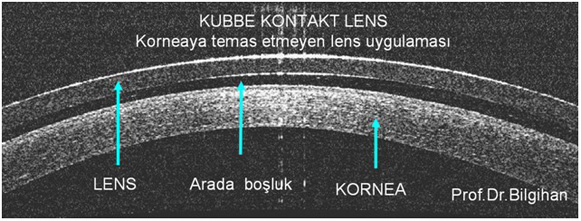 Kubbe kontakt lens: Korneaya temas etmeyen lens uygulaması.
