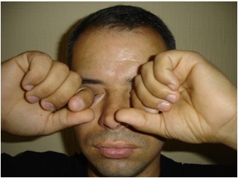 Gözün ovuşturulması veya allerji nedeniyle kaşınması